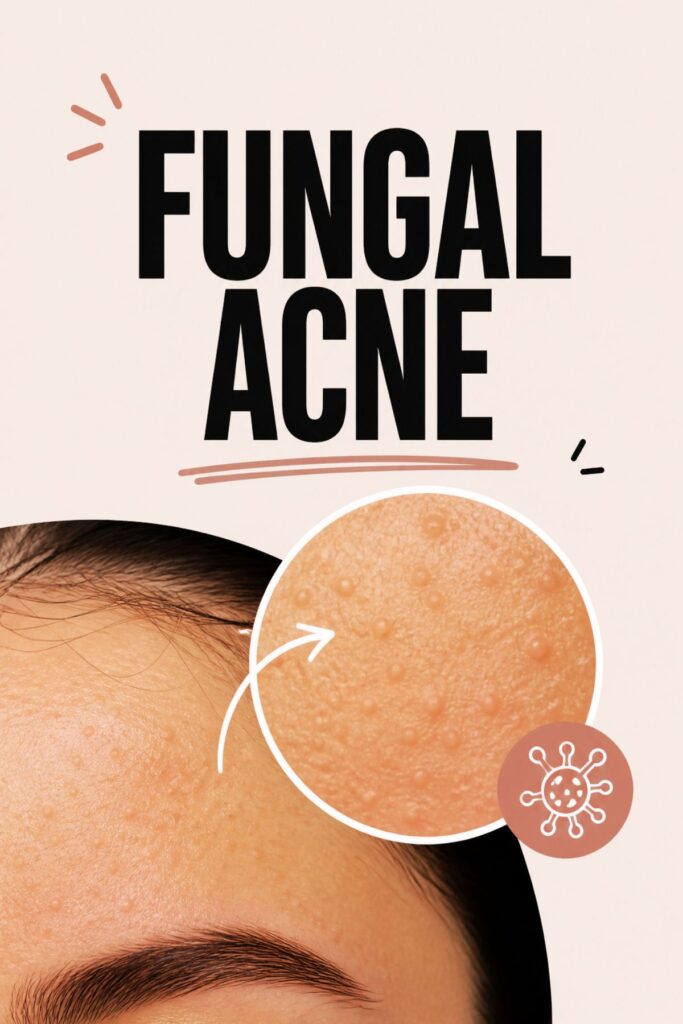 fungal acne