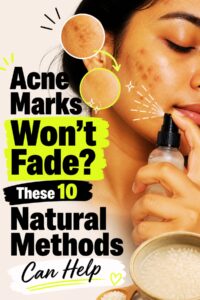 how to remove acne marks