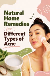 home remedies for acne to treat all types of breakouts
