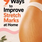 stretch mark remedies