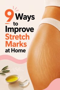 stretch mark remedies